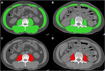 Age-specific reference values for low psoas muscle index at the L3 vertebra level in healthy populations: A multicenter study